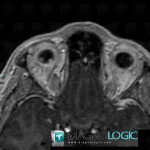 Hemangioblastoma, Eye, MRI