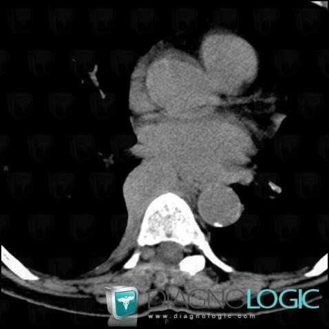 Hemangioblastoma, Mediastinum, CT