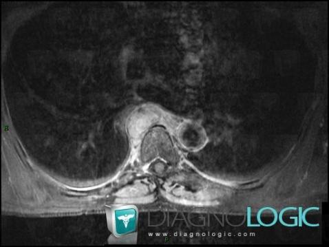 Hemangioblastoma, Paraspinal, MRI