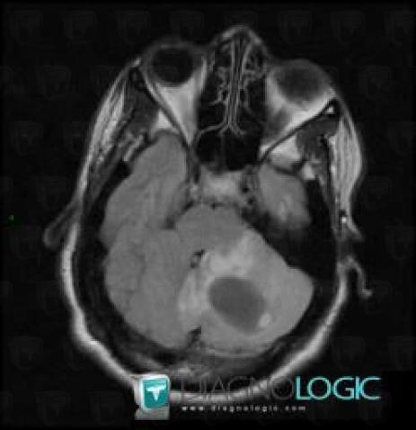 Hemangioblastoma, Posterior fossa, MRI