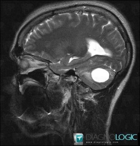 Hemangioblastoma, Posterior fossa, MRI