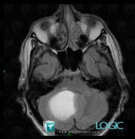 Hemangioblastoma, Posterior fossa, MRI