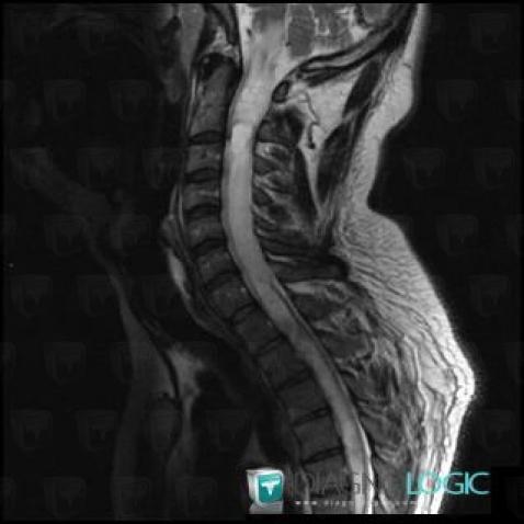 Hemangioblastoma, Spinal canal / Cord, MRI