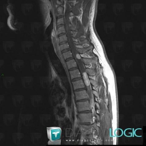 Hemangioblastoma, Spinal canal / Cord, MRI