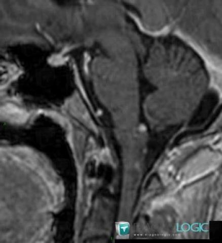 Hémangioblastome, Espaces peri cérébraux infratentoriels, IRM
