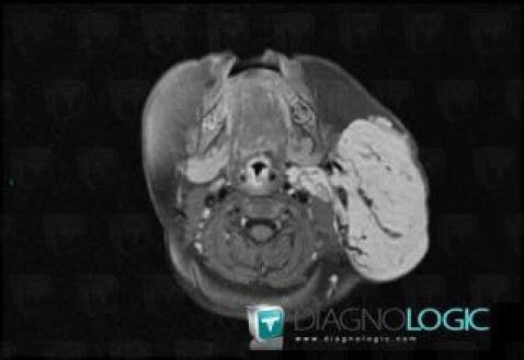 Hemangioma, Deep facial spaces, MRI