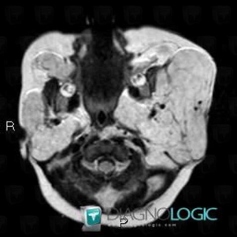 Hemangioma, Deep facial spaces, Parotid and other salivary glands, MRI