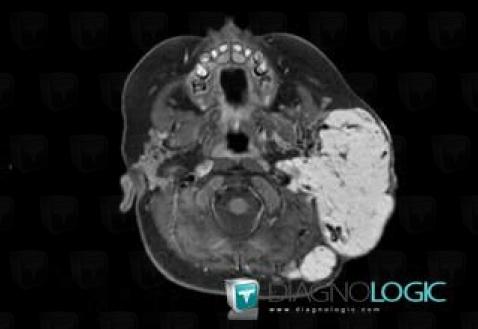 Hemangioma, Deep facial spaces, Parotid and other salivary glands, MRI