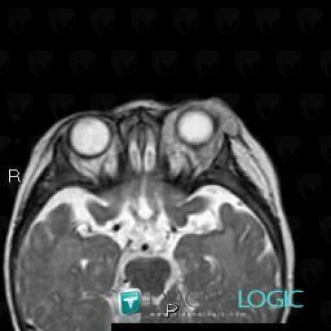 Hemangioma, Eye, MRI