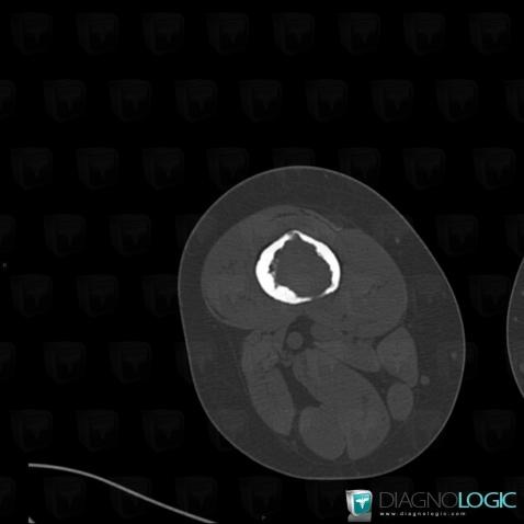 Hemangioma, Femur - Mid part, CT