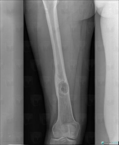 Hemangioma, Femur - Mid part, X rays