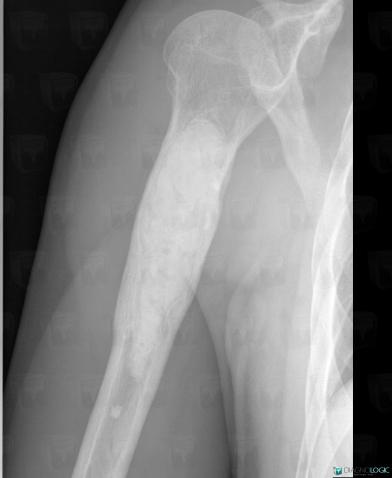 Hemangioma, Humerus - Mid part, X rays