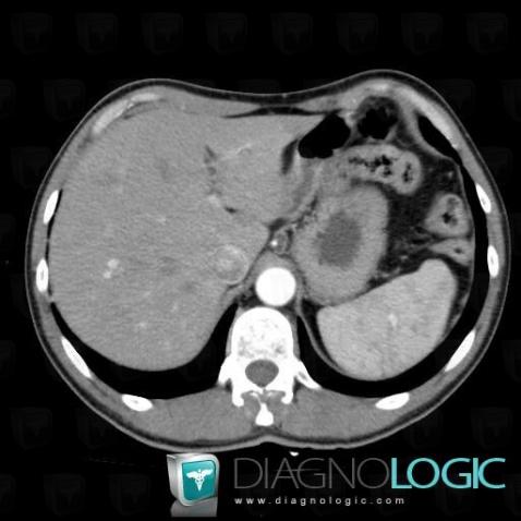 Hemangioma, Liver, CT