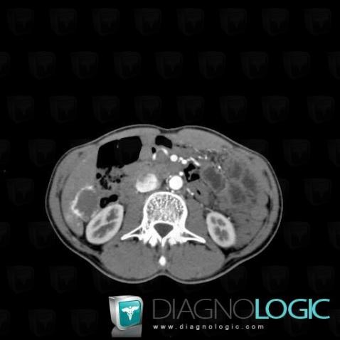 Hemangioma, Liver, CT