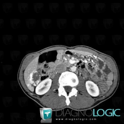 Hemangioma, Liver, CT