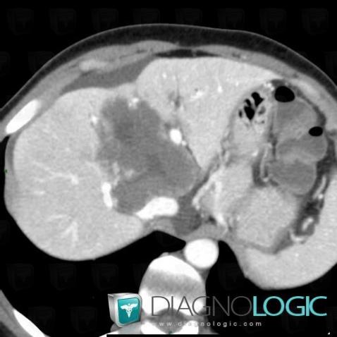 Hemangioma, Liver, CT