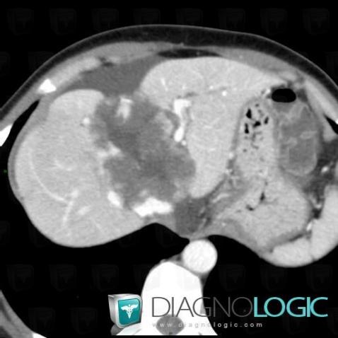 Hemangioma, Liver, CT