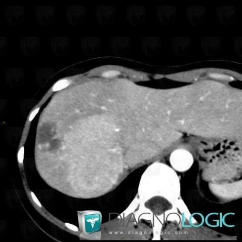 Hemangioma, Liver, CT