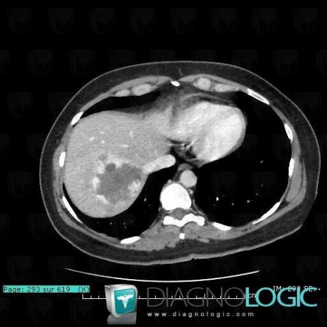 Hemangioma, Liver, CT