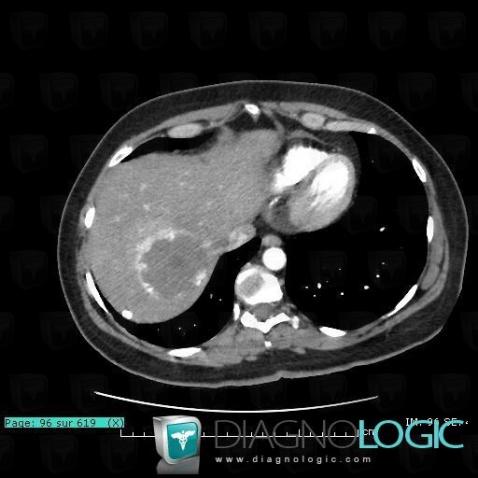 Hemangioma, Liver, CT