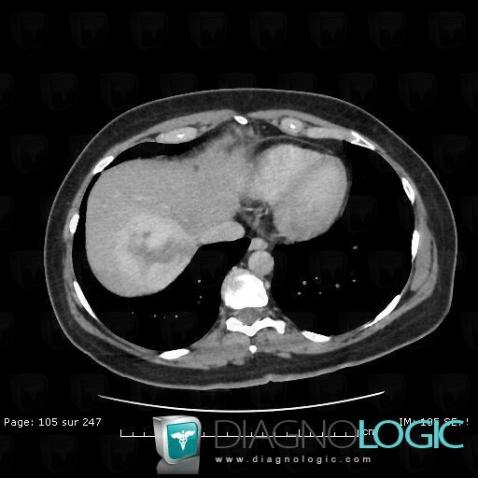 Hemangioma, Liver, CT