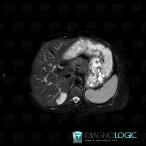 Hemangioma, Liver, MRI