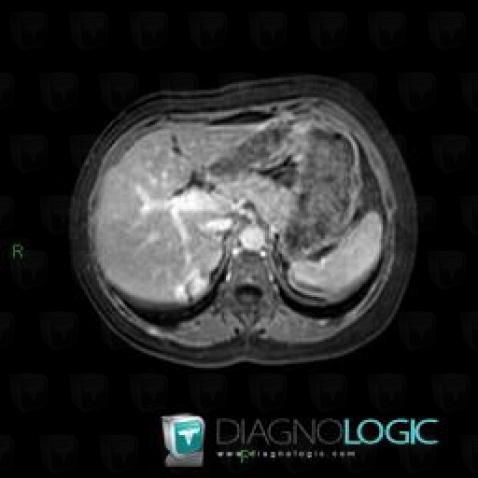 Hemangioma, Liver, MRI