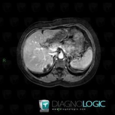 Hemangioma, Liver, MRI