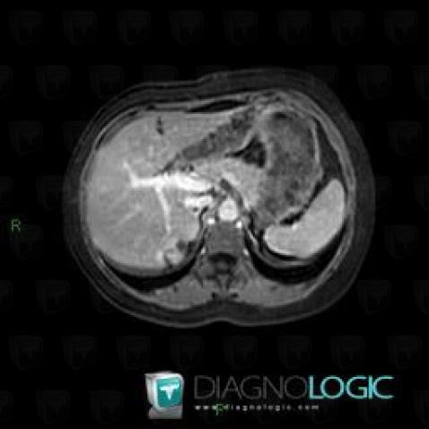 Hemangioma, Liver, MRI