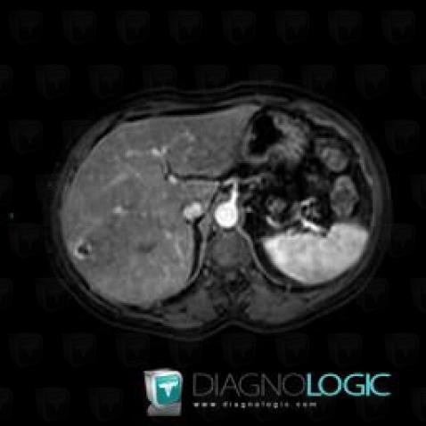 Hemangioma, Liver, MRI