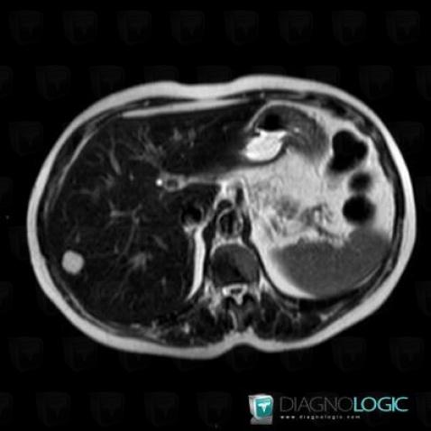 Hemangioma, Liver, MRI