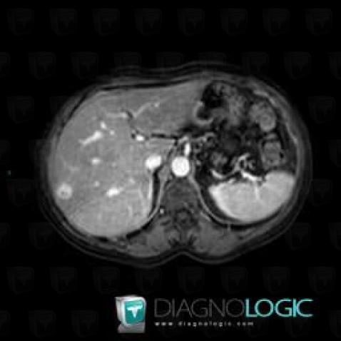 Hemangioma, Liver, MRI