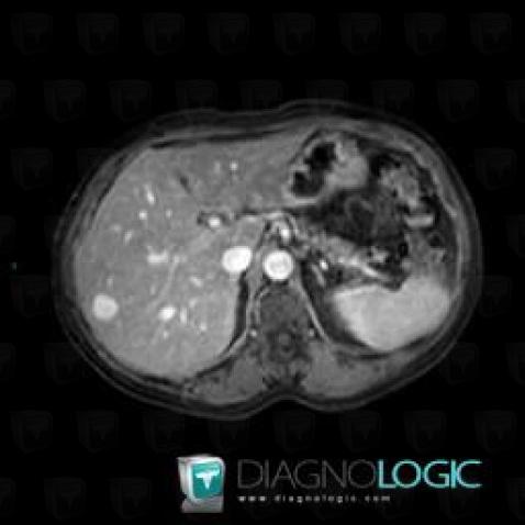 Hemangioma, Liver, MRI