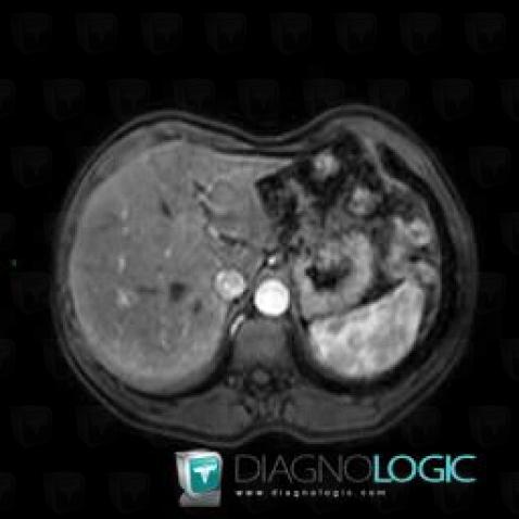 Hemangioma, Liver, MRI