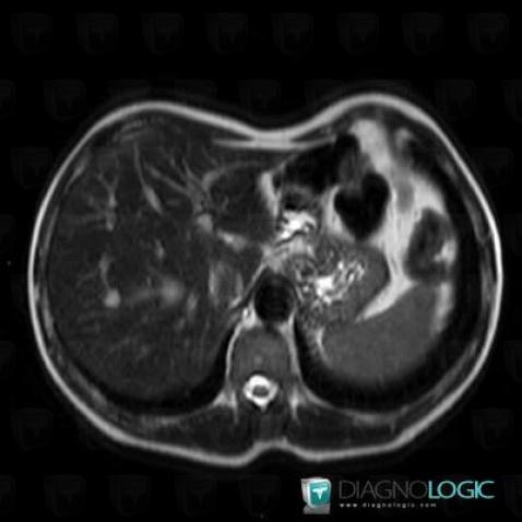 Hemangioma, Liver, MRI