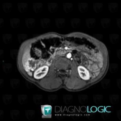 Hemangioma, Liver, MRI