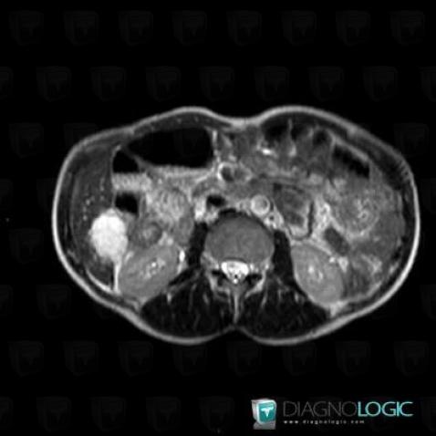 Hemangioma, Liver, MRI