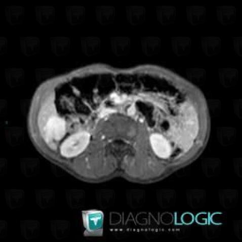 Hemangioma, Liver, MRI