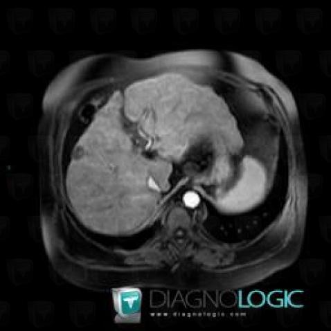 Hemangioma, Liver, MRI