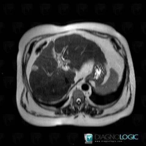 Hemangioma, Liver, MRI