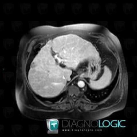 Hemangioma, Liver, MRI