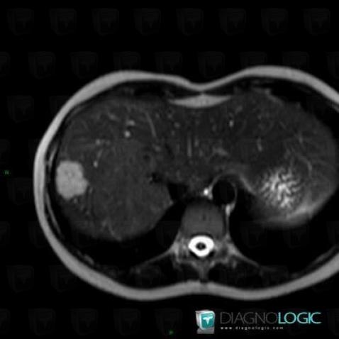 Hemangioma, Liver, MRI