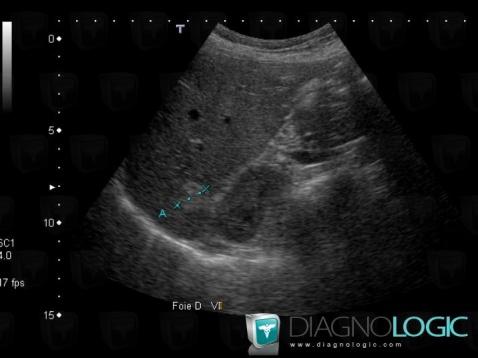 Hemangioma, Liver, US