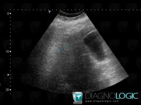 Hemangioma, Liver, US