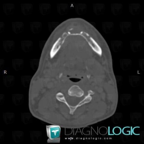 Hemangioma, Mandible, CT