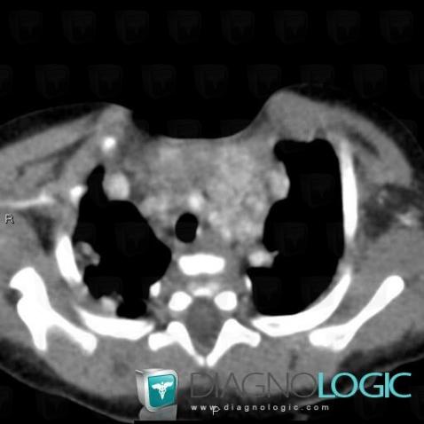 Hemangioma, Mediastinum, CT