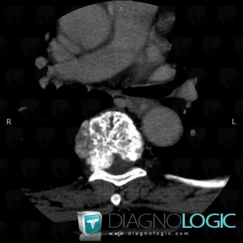 Hemangioma, Mediastinum, Paraspinal, CT