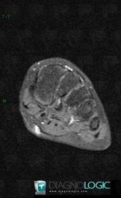 Hemangioma, Other soft tissues/nerves - Foot, MRI