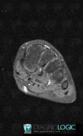 Hemangioma, Other soft tissues/nerves - Foot, MRI