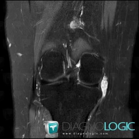 Hemangioma, Other soft tissues/nerves - Knee, MRI